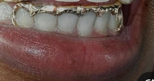 Gold Plated Silver 6 Bottom Solid Outline Bridge with J-Hook Canines