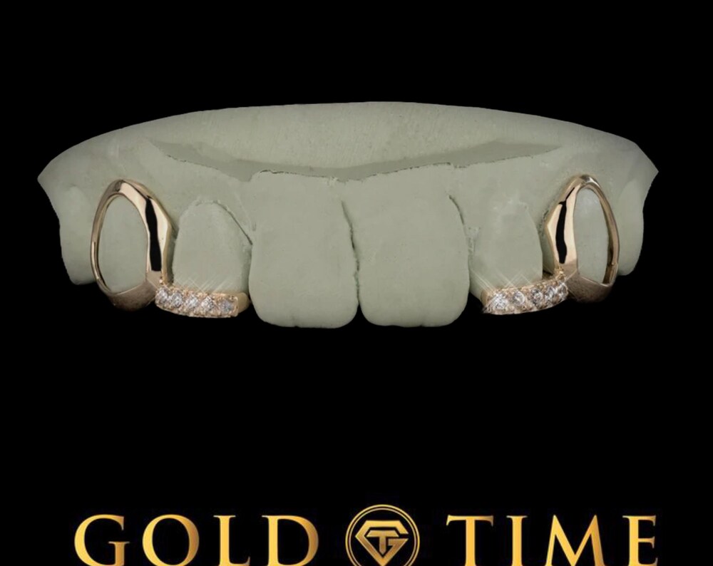 Custom 4-Piece Open Face Grillz with CZ Tip Incisors