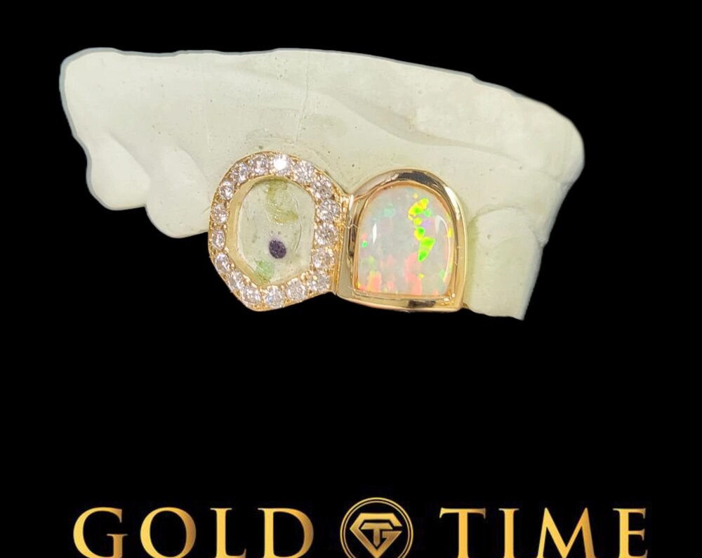 Custom Double Cap Grillz – Opalesque Incisor & Open Face Moissanite Fang